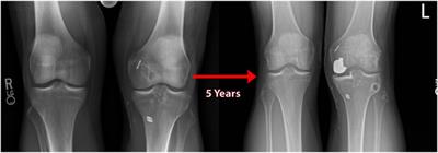 The Natural History of Medial Meniscal Root Tears: A Biomechanical and Clinical Case Perspective